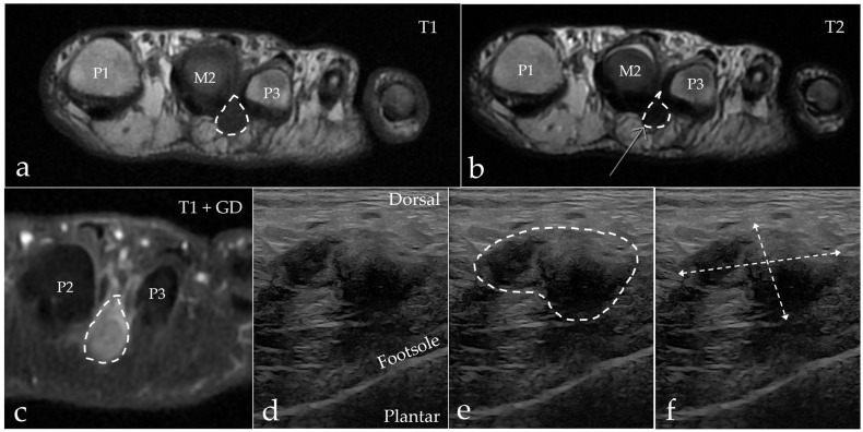 Morton’s (interdigital) neuroma. Second-web-space neuroma on MRI (T1, T2 and contrast-enhanced, top) and ultrasound (bottom), outlined and measured. Diagnostics 2025;15:1339, Fig. 4 (CC BY 4.0).