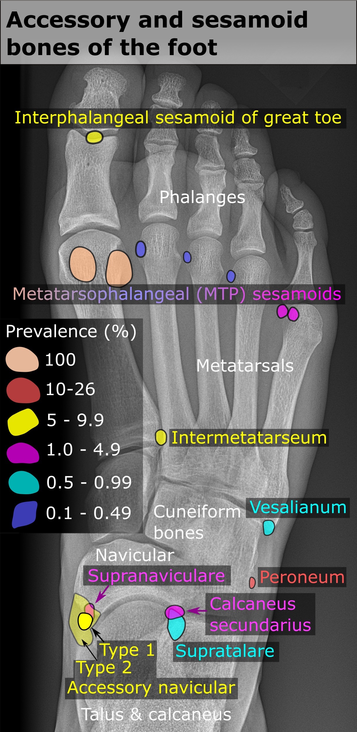 Sesamoid and accessory bones of the foot. Labelled dorsoplantar radiograph showing the hallux metatarsophalangeal sesamoids and the accessory ossicles. Mikael Häggström, Wikimedia Commons, CC0.