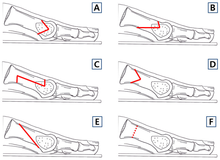 First-metatarsal osteotomy techniques (schematic). Labelled lateral diagrams of the principal first-metatarsal osteotomies used for hallux valgus. Cho et al., J Clin Med 2025;14:5072, Fig. 3 (CC BY 4.0).