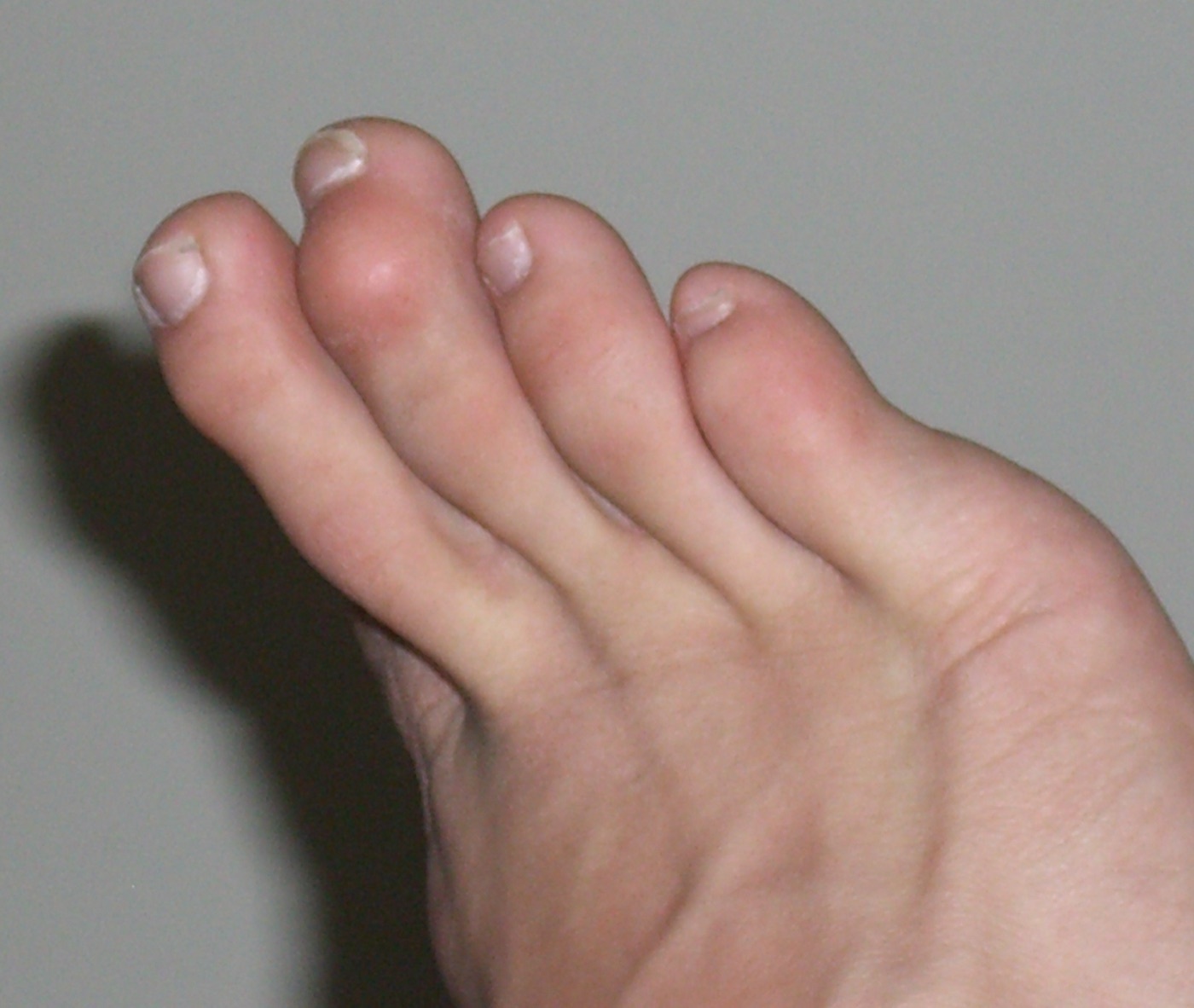 Mallet toe. Distal interphalangeal flexion of a lesser toe - useful for contrasting the joint level with the hammer/claw deformity above. Bprender22, Wikimedia Commons, public domain.