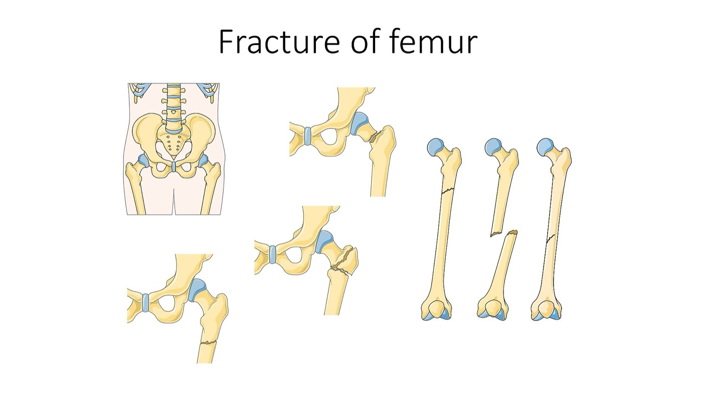 Figure 2. Femoral fracture patterns (neck, intertrochanteric with fragment displacement, and shaft), illustrating how the proximal fragment displaces relative to the shaft under opposing muscle pulls. Illustration by Laboratoires Servier (Servier Medical Art), CC BY-SA 3.0, via Wikimedia Commons.
