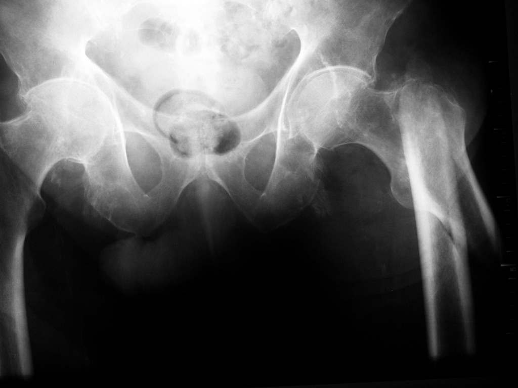 Figure 5. The same subtrochanteric fracture on an AP pelvis radiograph, showing displacement of the distal (shaft) fragment relative to the proximal trochanteric fragment. Image by THWZ, CC BY-SA 3.0, via Wikimedia Commons.