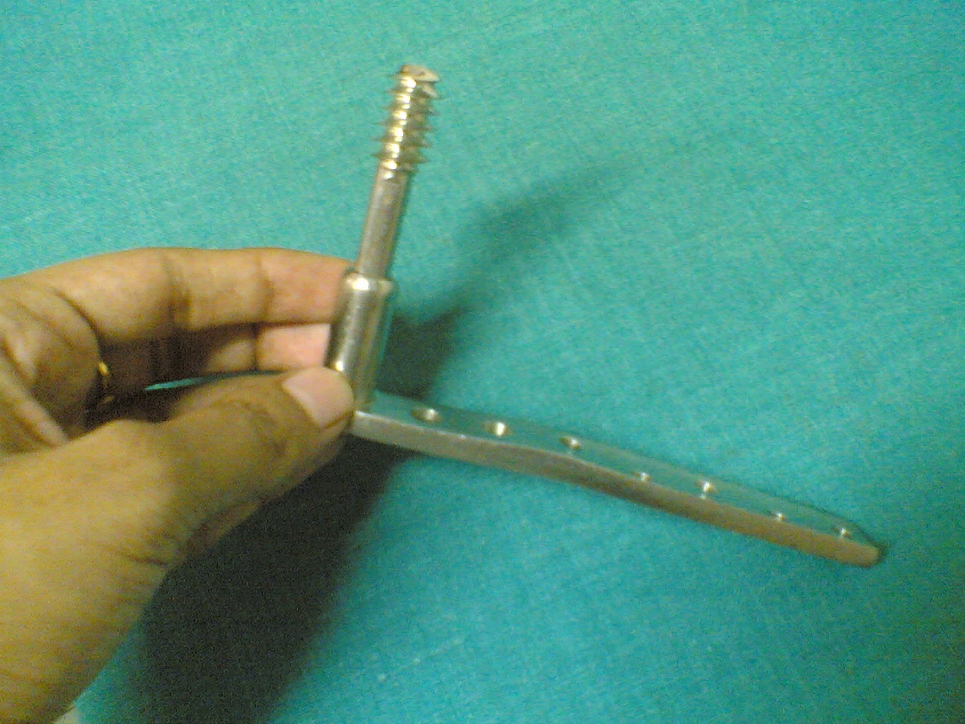 Figure 6. Dynamic condylar screw (DCS): a condylar lag screw fixed to an angled (≈95°) side plate - the fixed-angle plating alternative reserved for cases unsuitable for a nail or for nonunion/malunion reconstruction. Image by Netha Hussain, CC BY-SA 3.0, via Wikimedia Commons.