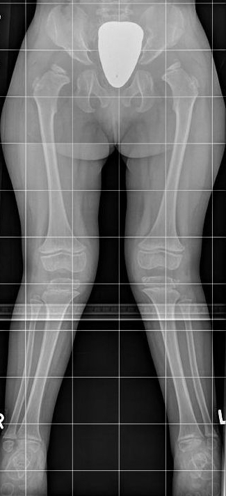 Genu valgum in Morquio disease (MPS IV). Standing lower-limb radiograph showing knock-knees with metaphyseal and epiphyseal dysplasia. Kinderradiologie Olgahospital, Klinikum Stuttgart, Wikimedia Commons (CC BY-SA 4.0).