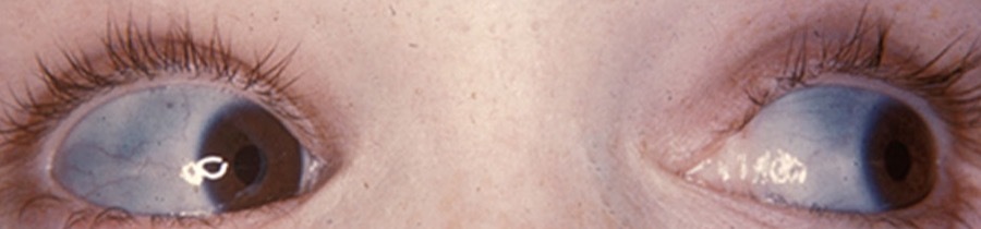 Blue sclerae in osteogenesis imperfecta. The thin sclera transmits the underlying choroid, giving the characteristic blue hue (eye-only crop). Fred & van Dijk, Images of Memorable Cases (CC BY-SA 3.0, cropped).