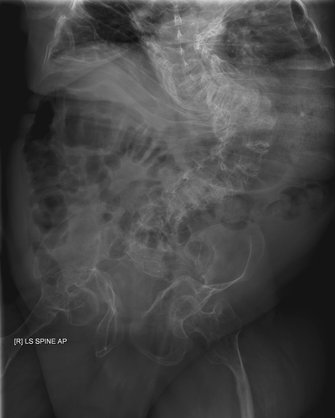 Bone fragility in osteogenesis imperfecta. Adult radiograph showing gracile (thin) bones with severe scoliosis and thoracic deformity. Fredrick Brennan, Wikimedia Commons (public domain).