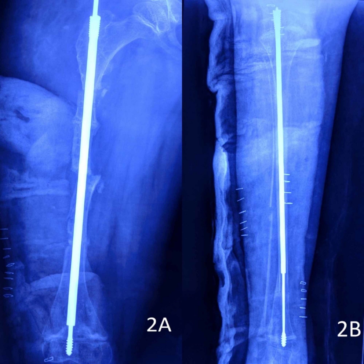 Intramedullary rodding in osteogenesis imperfecta. Post-operative radiographs of a long bone with a telescoping (Fassier-Duval-type) intramedullary rod after realignment. Behera et al., Cureus 2020, via Wikimedia Commons (CC BY 4.0).