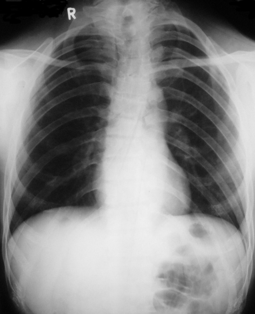 Cleidocranial dysplasia. Chest radiograph showing absent/hypoplastic clavicles and a bell-shaped thorax. Garg & Agrawal, Cases Journal 2008;1:377, via Wikimedia Commons (CC BY 2.0).