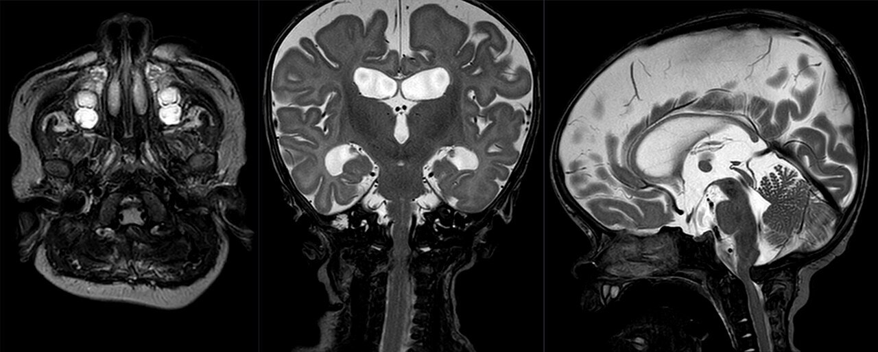 Foramen-magnum stenosis in achondroplasia. Infant craniocervical MRI (axial, coronal and sagittal T2): the sagittal view shows the narrowed foramen magnum and cervicomedullary junction, with ventriculomegaly. Hellerhoff, Wikimedia Commons (CC BY-SA 4.0).