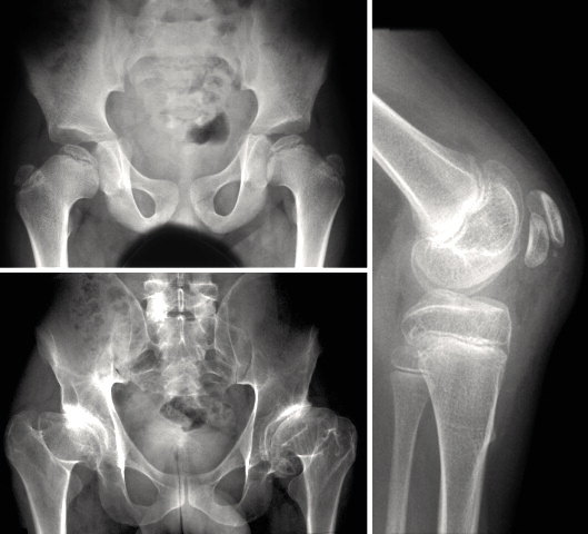 Multiple epiphyseal dysplasia. Small, irregular, fragmented epiphyses at the hips (AP pelvis) and knee. Bellllacullllen, Wikimedia Commons (CC BY-SA 3.0).