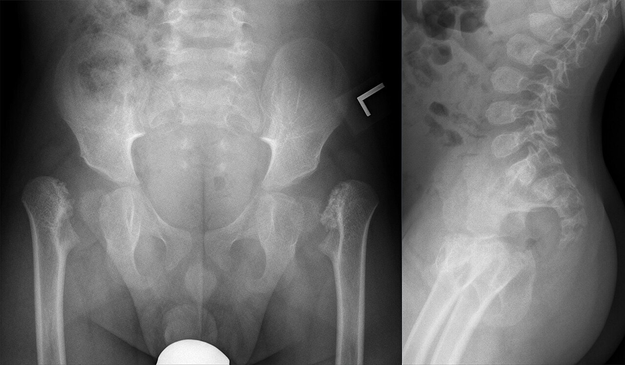 Spondyloepiphyseal dysplasia congenita. Infant AP pelvis (delayed femoral-head ossification, dysplastic epiphyses) and lateral spine (ovoid, flattened vertebrae - platyspondyly). Hellerhoff, Wikimedia Commons (CC BY-SA 4.0).