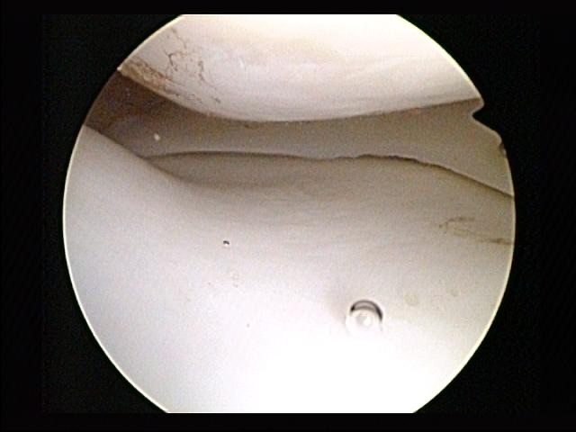 Figure 17. Arthroscopic intra-articular view of a normal medial meniscus seated between the femoral condyle and the tibial plateau. Arthroscopist, CC BY-SA 4.0, via Wikimedia Commons.
