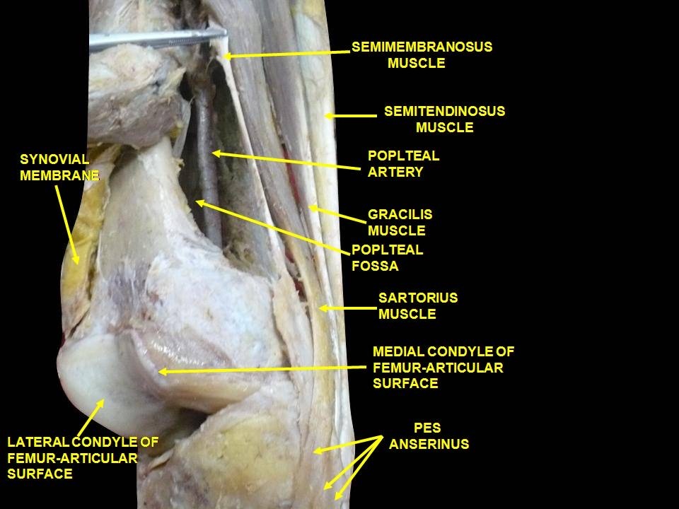Figure 20. Cadaveric dissection of the medial aspect of the knee: the pes anserinus formed by sartorius, gracilis and semitendinosus, with the popliteal vessels behind. Anatomist90, CC BY-SA 3.0, via Wikimedia Commons.