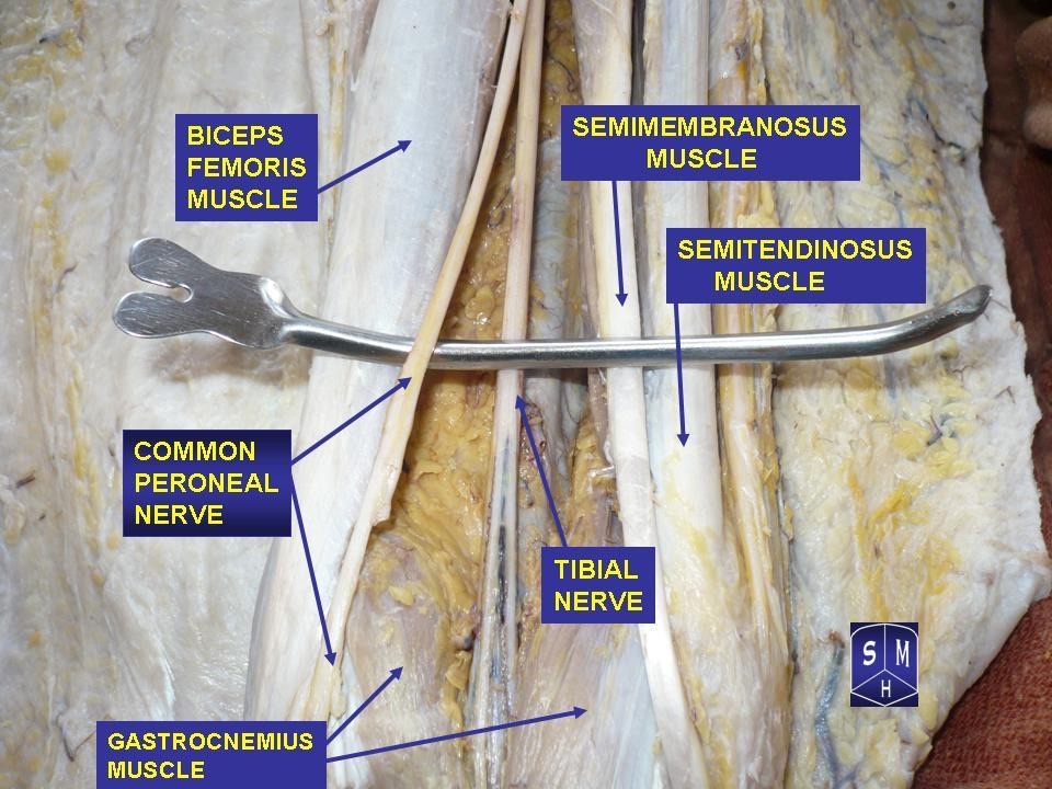 Figure 23. Cadaveric dissection at the knee: the sciatic nerve dividing into the tibial and common peroneal (fibular) nerves, with biceps femoris marking the lateral boundary and the common peroneal nerve passing toward the fibular neck. Anatomist90, CC BY-SA 3.0, via Wikimedia Commons.