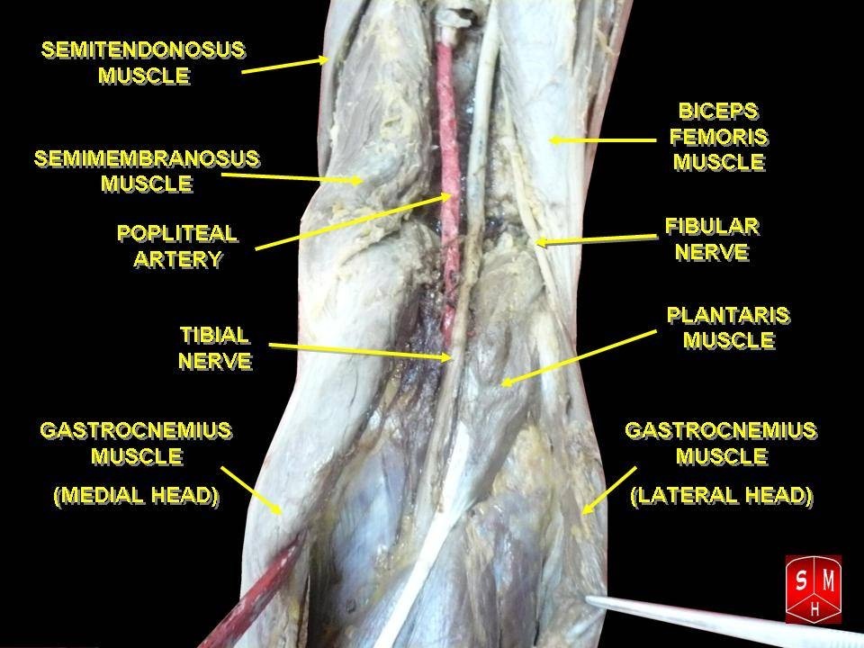 Figure 24. Dissection of the popliteal fossa: the muscular boundaries (semitendinosus and semimembranosus medially, biceps femoris laterally, the two heads of gastrocnemius inferiorly) and the popliteal artery, tibial nerve and common peroneal nerve. Anatomist90, CC BY-SA 3.0, via Wikimedia Commons.