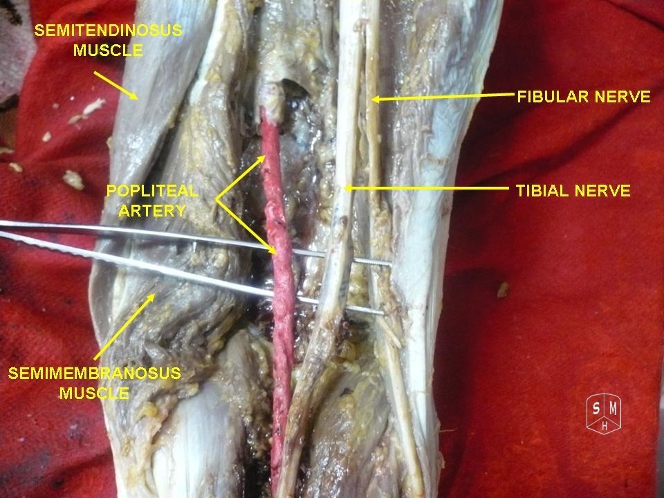 Figure 25. A second popliteal fossa dissection showing the tibial and fibular (common peroneal) nerves and the popliteal artery; the popliteal vein lies between the tibial nerve and the artery in the superficial-to-deep order. Anatomist90, CC BY-SA 3.0, via Wikimedia Commons.