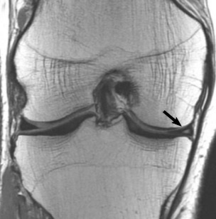 Figure 27. Coronal proton-density MRI of a grade-2 medial meniscal tear (arrow). Lefevre et al. (2016), CC BY 4.0, via Wikimedia Commons.
