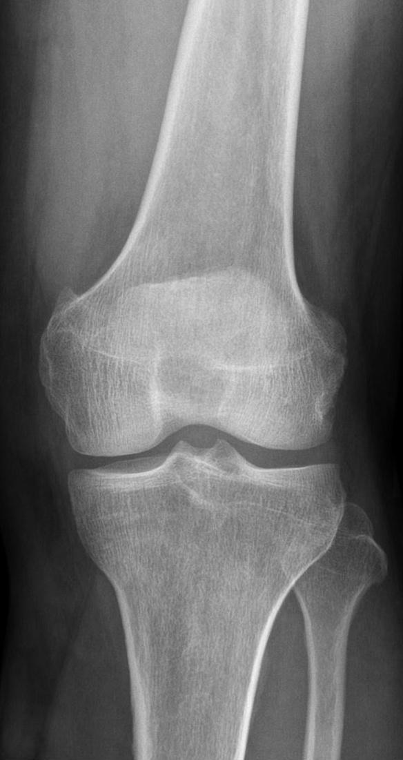 Figure 1. Normal anteroposterior radiograph of the knee, showing the femoral condyles, the tibial plateau and intercondylar eminence, and the proximal fibula. Hellerhoff, CC BY-SA 4.0, via Wikimedia Commons.