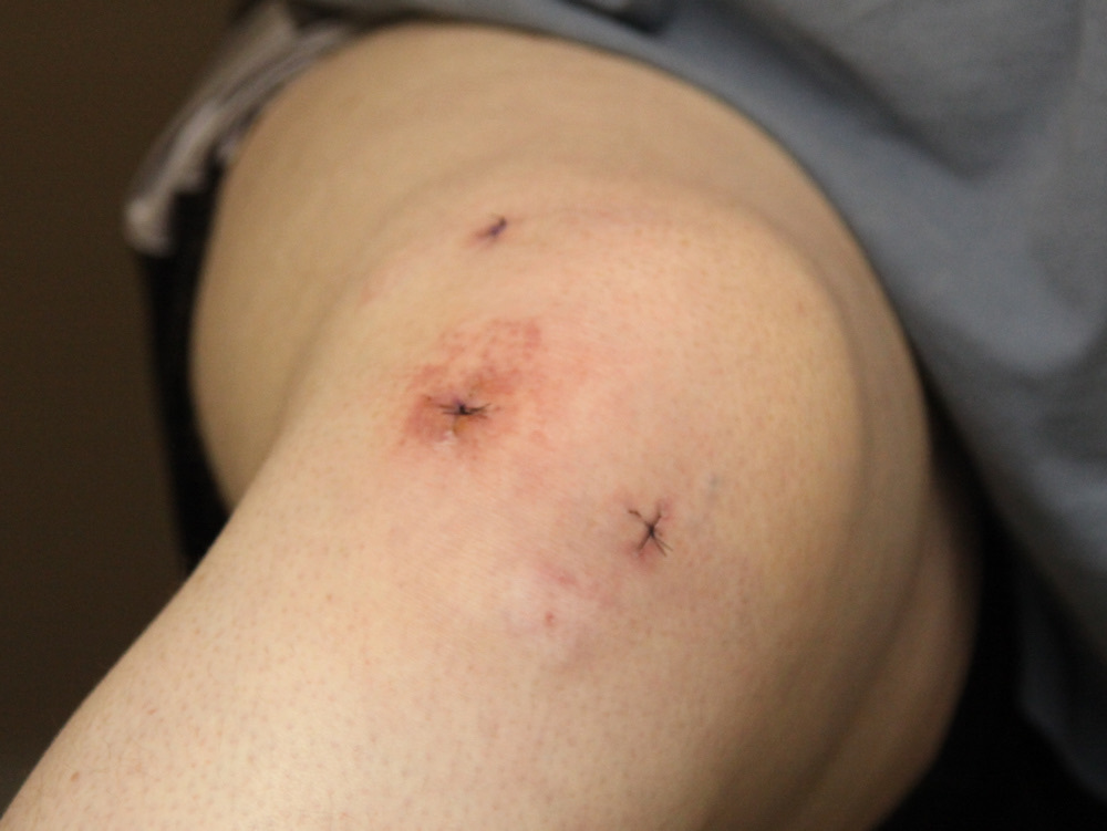 Figure 15. The front of a flexed knee showing the standard anterolateral and anteromedial arthroscopy portal sites flanking the patellar tendon, with a superior (suprapatellar) portal. Tim1965, CC BY-SA 3.0, via Wikimedia Commons.