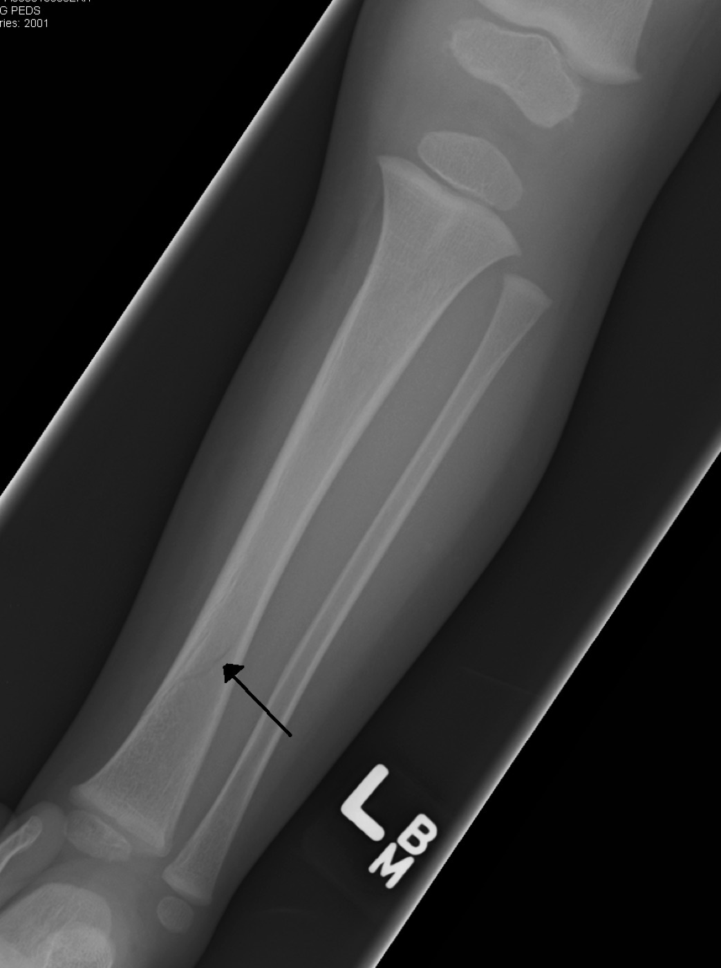 Figure 15. Toddler’s fracture: a subtle, undisplaced spiral fracture of the distal tibial shaft (arrow) in a young child with open physes. Image by James Heilman, MD, CC BY-SA 3.0, via Wikimedia Commons.