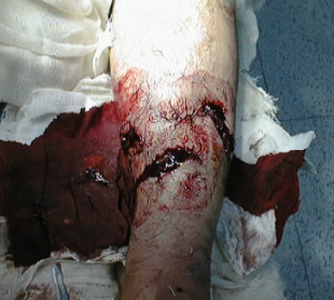 Figure 5. Gustilo-Anderson type II open fracture: a larger laceration with moderate soft-tissue injury. Image by Doncovska, CC BY-SA 3.0, via Wikimedia Commons.