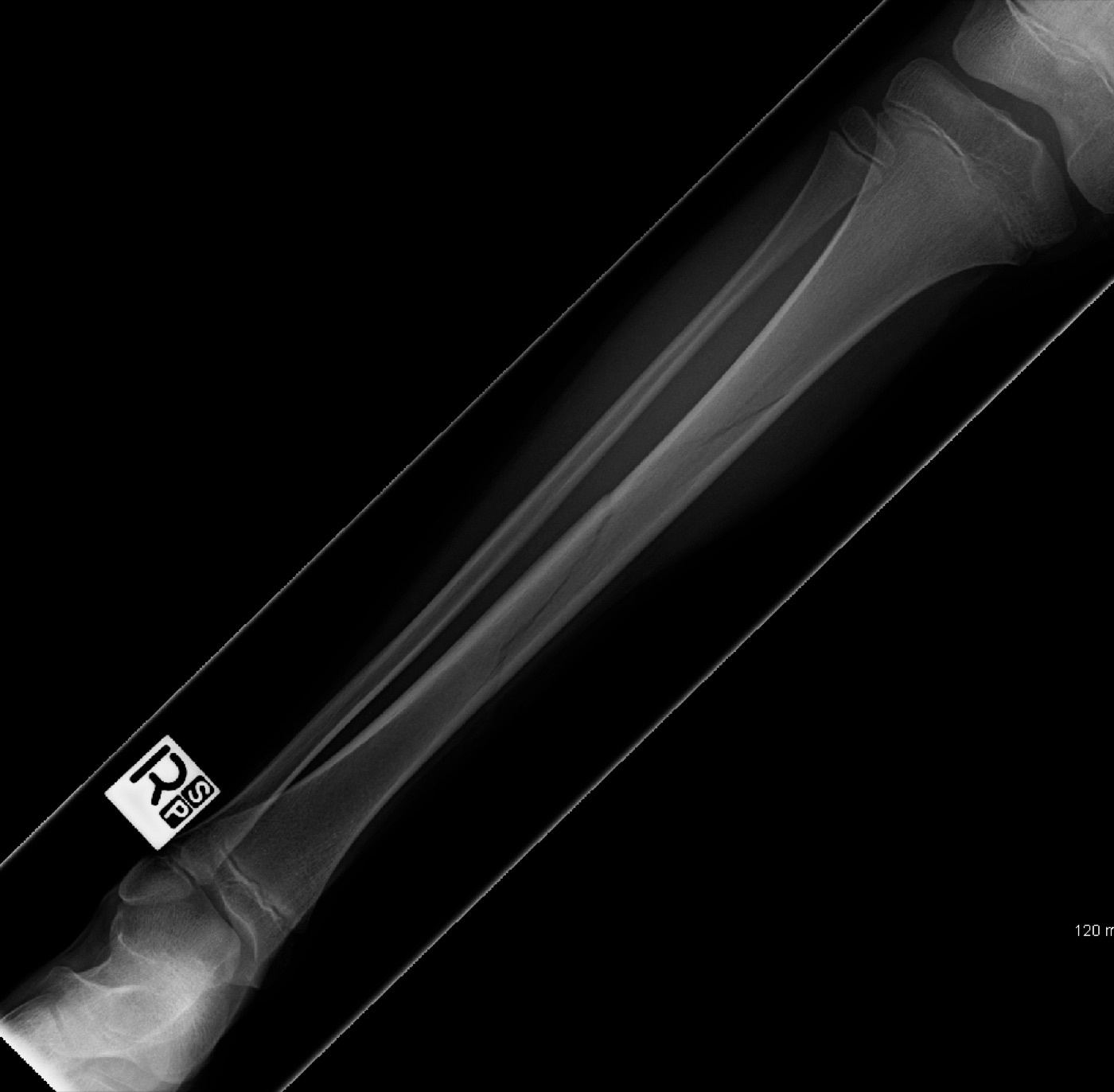 Figure 6. Spiral fracture of the tibial shaft, the low-energy torsional pattern. Image by James Heilman, MD, CC BY-SA 3.0, via Wikimedia Commons.