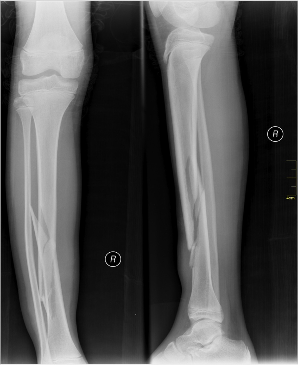 Figure 7. Oblique fracture of the tibial and fibular shafts with a butterfly fragment, AP and lateral radiographs. Image by Nevit Dilmen, CC BY-SA 3.0, via Wikimedia Commons.