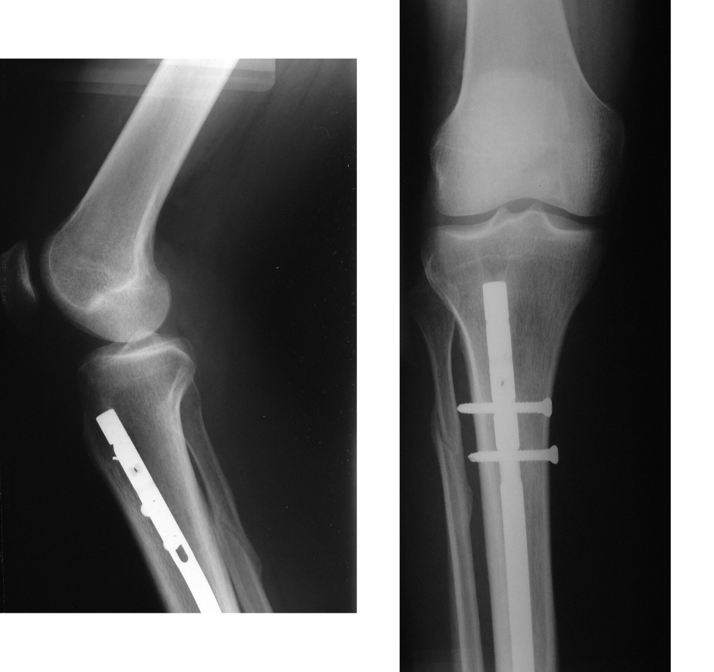 Figure 11. Tibial intramedullary nail with proximal interlocking screws, AP and lateral radiographs. Image by Kolossos, CC BY-SA 3.0, via Wikimedia Commons.