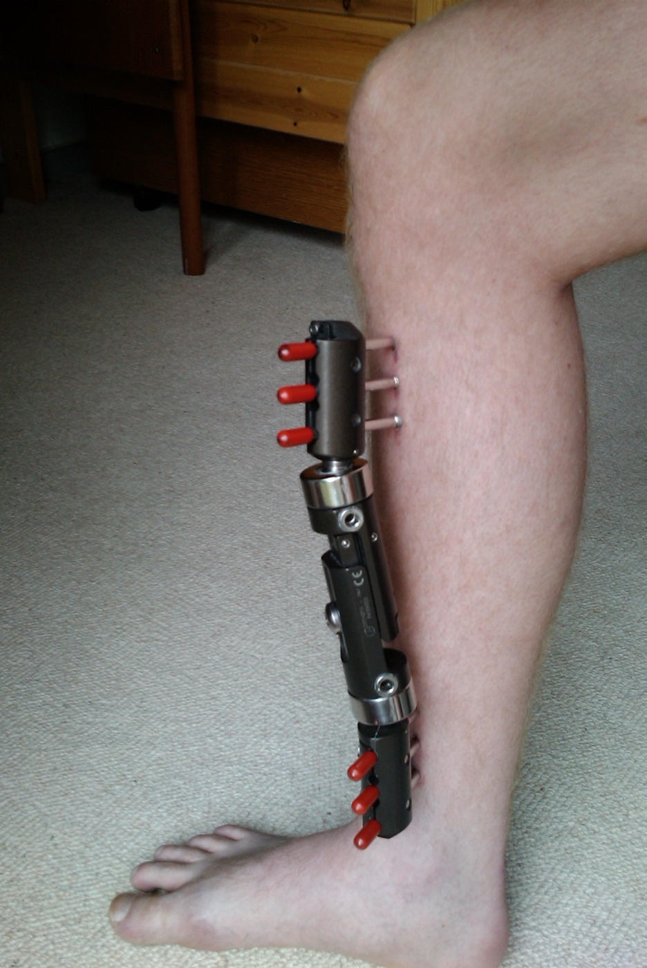 Figure 13. Monolateral external fixator applied to the tibia, used for damage control and severe open fractures. Image by Redhead.dk, CC BY 3.0, via Wikimedia Commons.