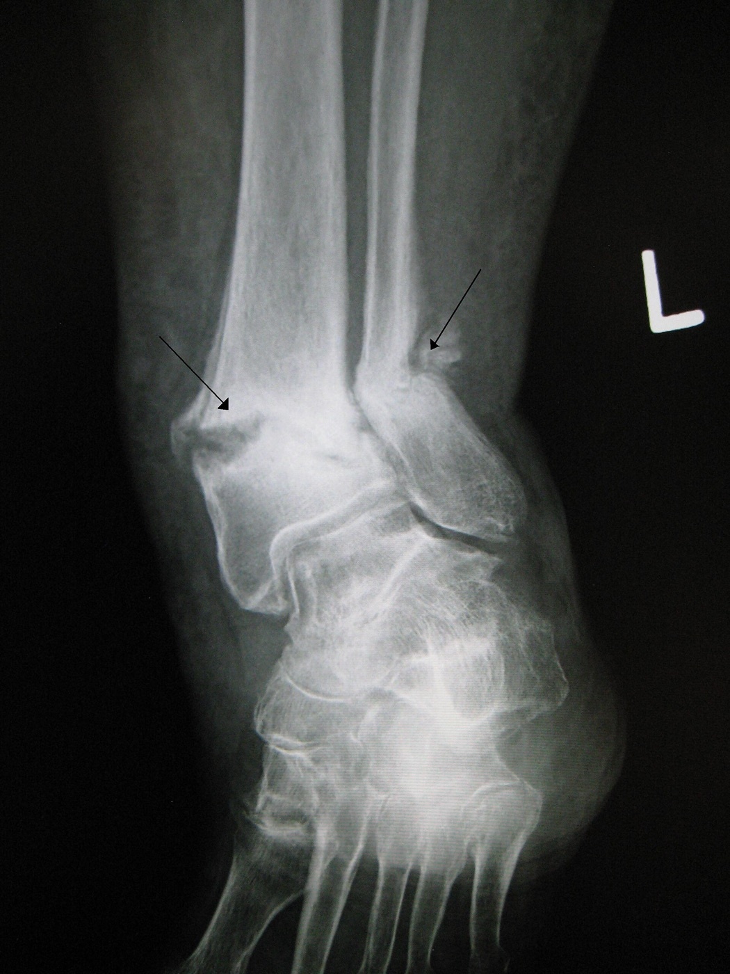 Figure 14. Tibial/fibular nonunion (pseudarthrosis, arrows) with no bridging callus across the fracture. Image by James Heilman, MD, CC BY-SA 3.0, via Wikimedia Commons.