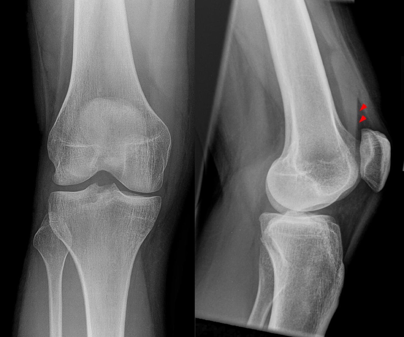 Figure 2. Occult tibial plateau fracture: a lipohaemarthrosis (fat-fluid level, arrowheads) in the suprapatellar recess signals an intra-articular fracture despite a near-normal AP view. Image by Hellerhoff, CC BY-SA 3.0, via Wikimedia Commons.