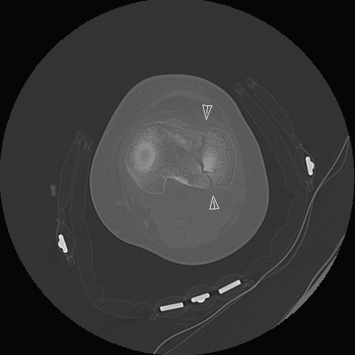 Figure 3. Axial CT of the proximal tibia showing a fracture line through the plateau (arrowheads); CT defines fragment geometry and articular involvement. Image by LottieLattes, CC BY-SA 4.0, via Wikimedia Commons.