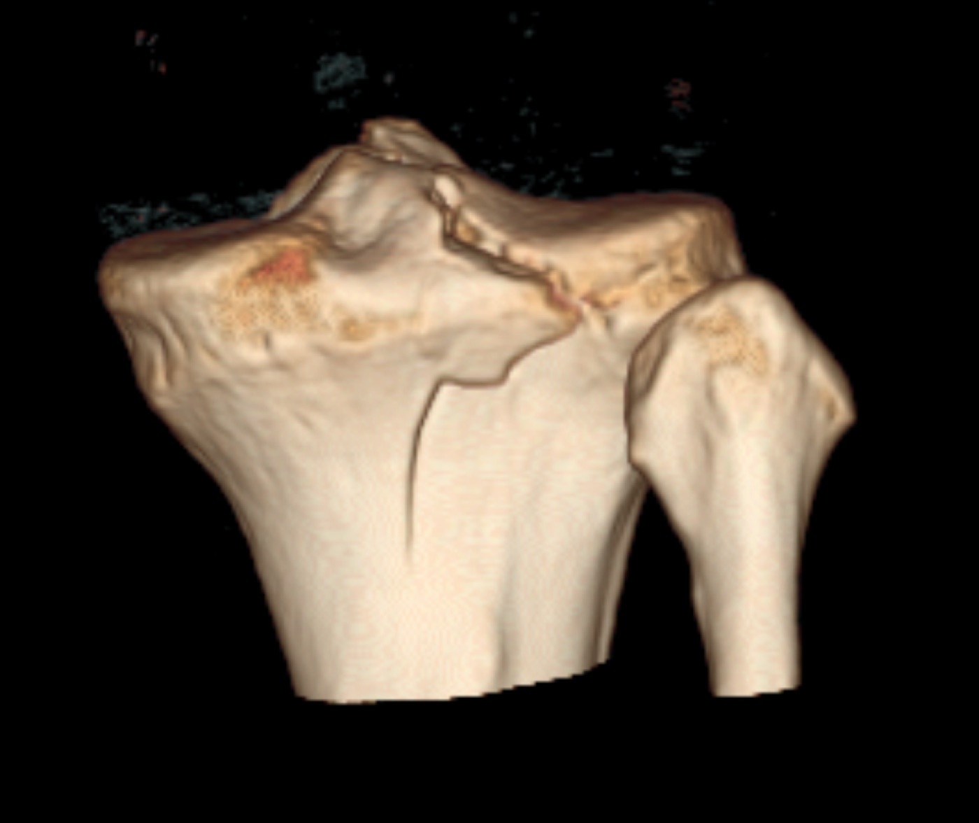 Figure 4. 3D CT reconstruction of a tibial plateau fracture, demonstrating the split through the articular surface. Image by James Heilman, MD, CC BY-SA 4.0, via Wikimedia Commons.
