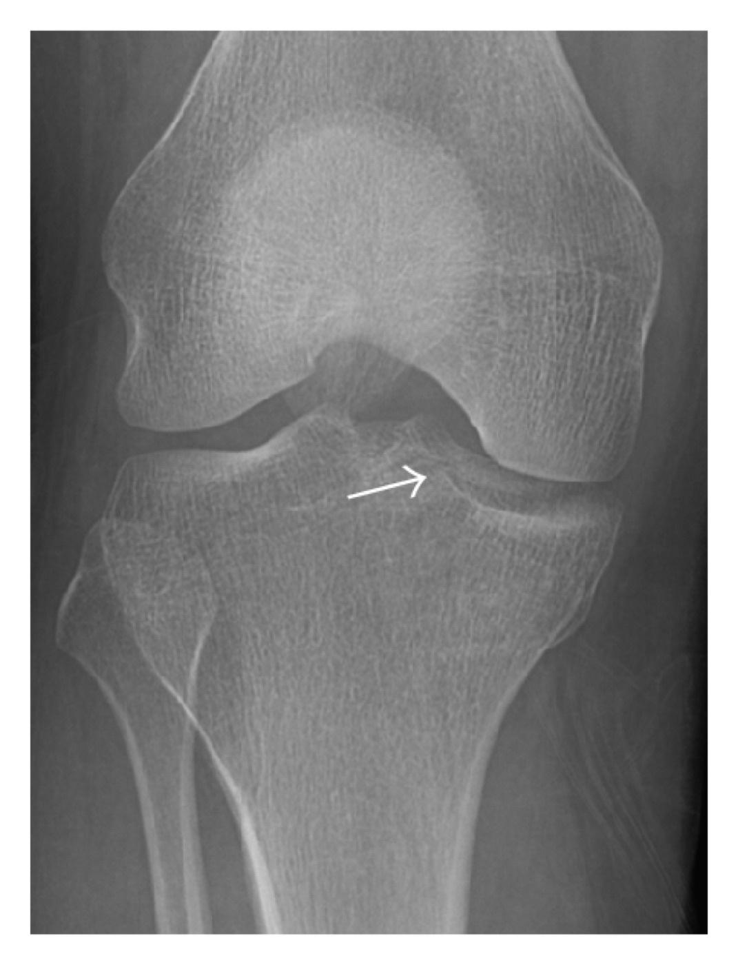 Figure 5. Subtle lateral tibial plateau fracture (arrow) on an AP knee radiograph, the kind easily missed without CT. Image by Jarraya et al., CC BY 3.0, via Wikimedia Commons.