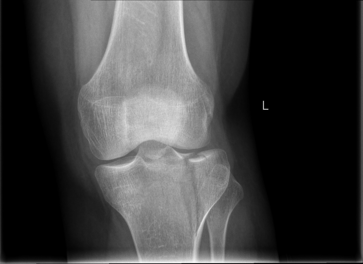Figure 6. AP knee radiograph showing a lateral tibial plateau fracture with articular depression. Image by LottieLattes, CC BY-SA 4.0, via Wikimedia Commons.