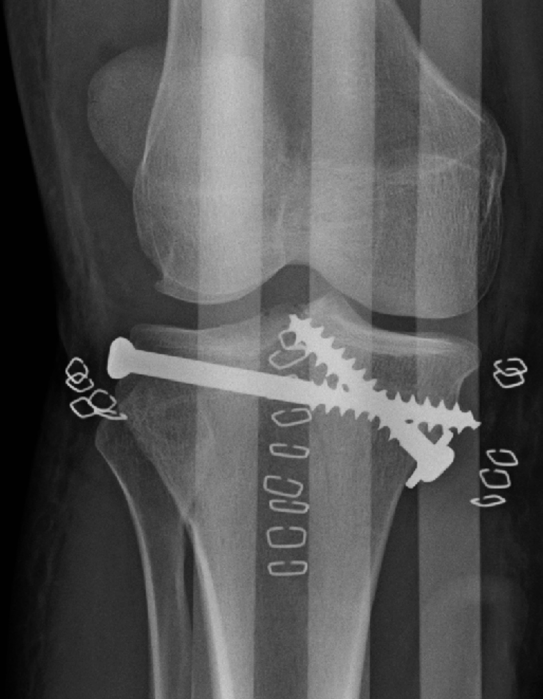 Figure 8. Post-operative radiograph after ORIF of a tibial plateau fracture: a lateral buttress plate with an interfragmentary screw. Image by James Heilman, MD, CC BY-SA 4.0, via Wikimedia Commons.