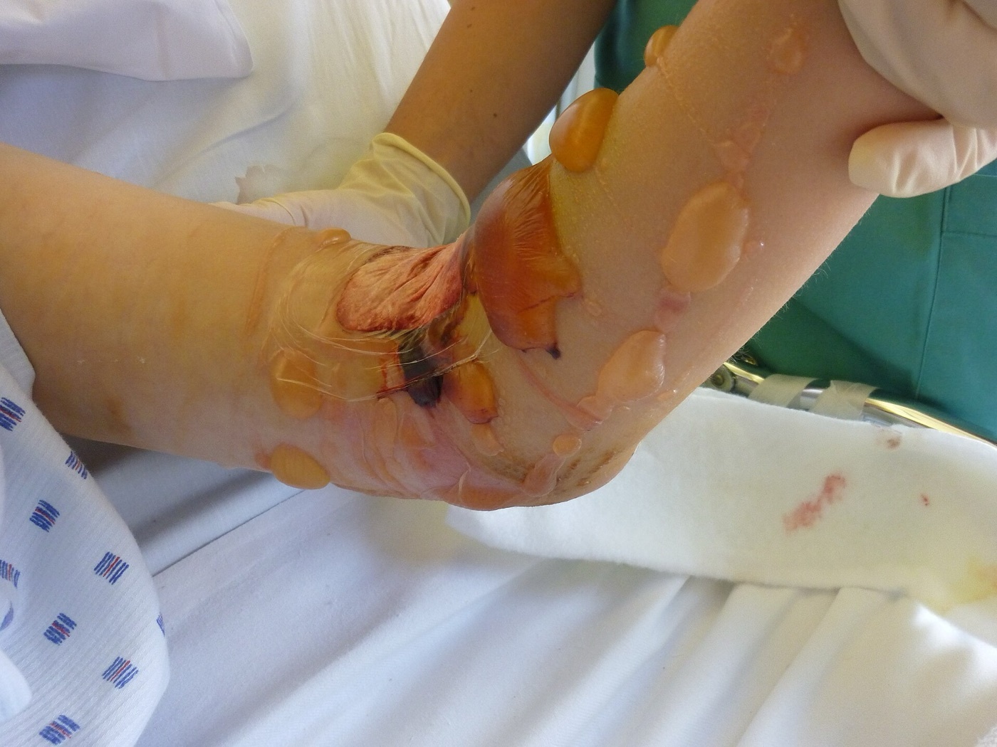 Figure 10. Extensive soft-tissue swelling and blistering of the lower leg, the degree of soft-tissue compromise that mandates delayed definitive fixation. Image by Lklundin, CC BY-SA 4.0, via Wikimedia Commons.