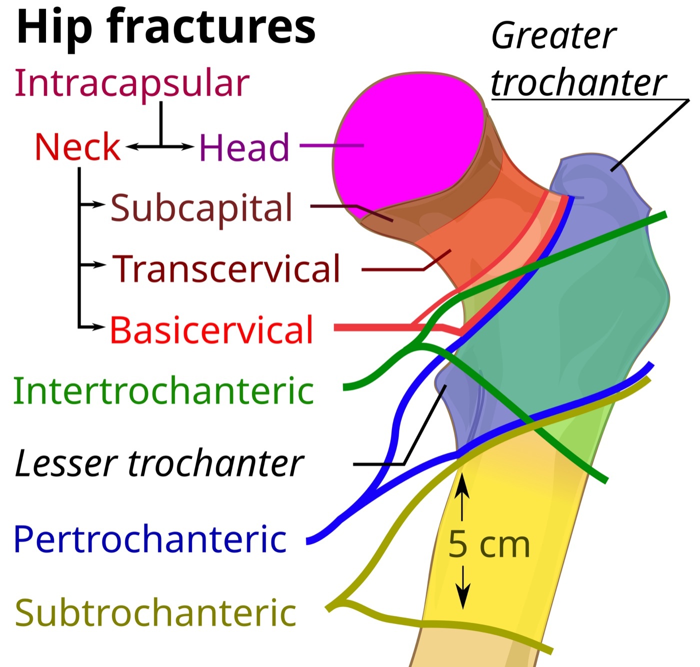 Figure 2. Anatomical classification of proximal femoral fractures: the intertrochanteric/pertrochanteric (extracapsular) zone relative to the trochanters and neck. Mikael Häggström, CC0, via Wikimedia Commons.
