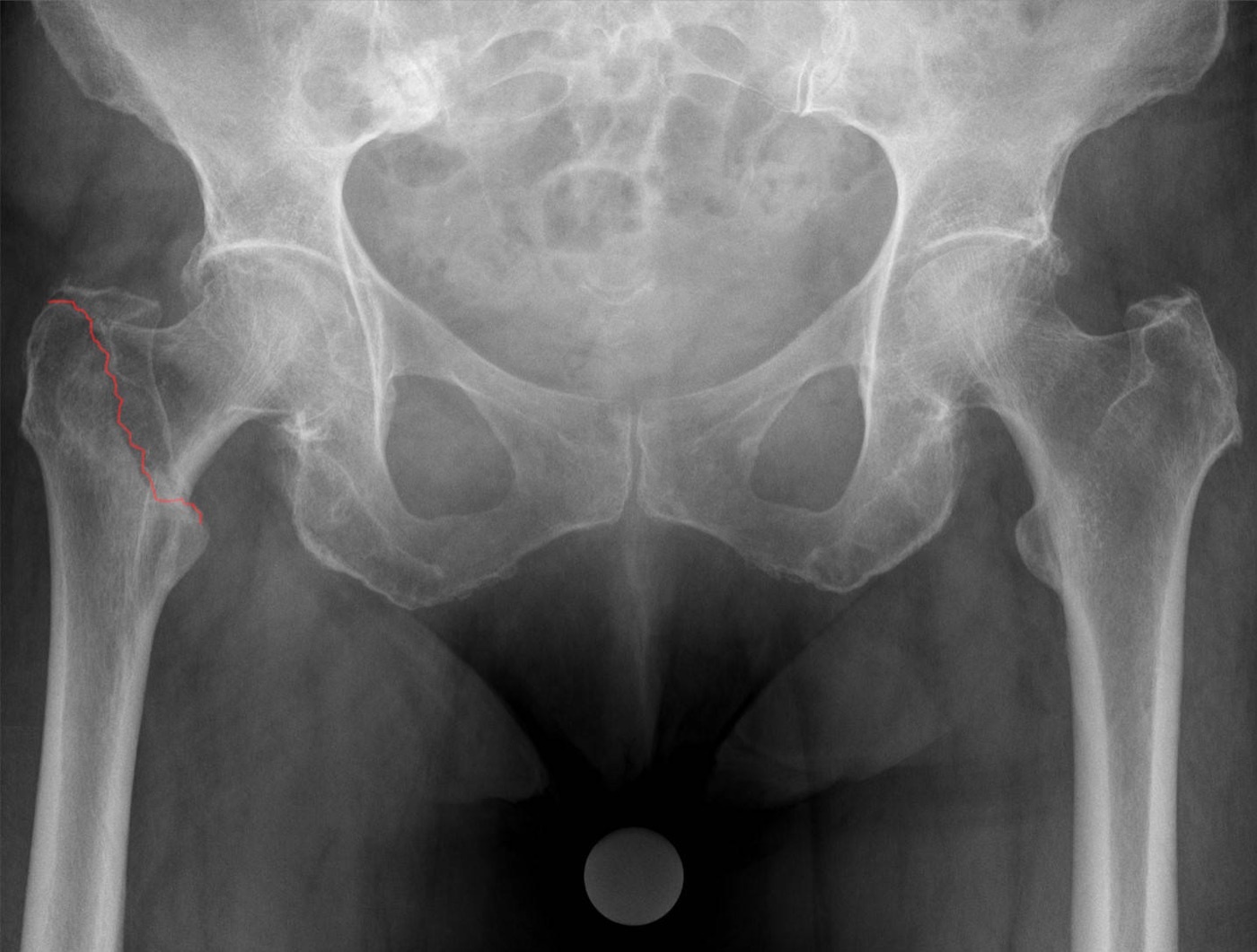 Figure 3. An undisplaced pertrochanteric (extracapsular) fracture on AP radiograph (fracture line in red). Hellerhoff, CC BY-SA 4.0, via Wikimedia Commons.