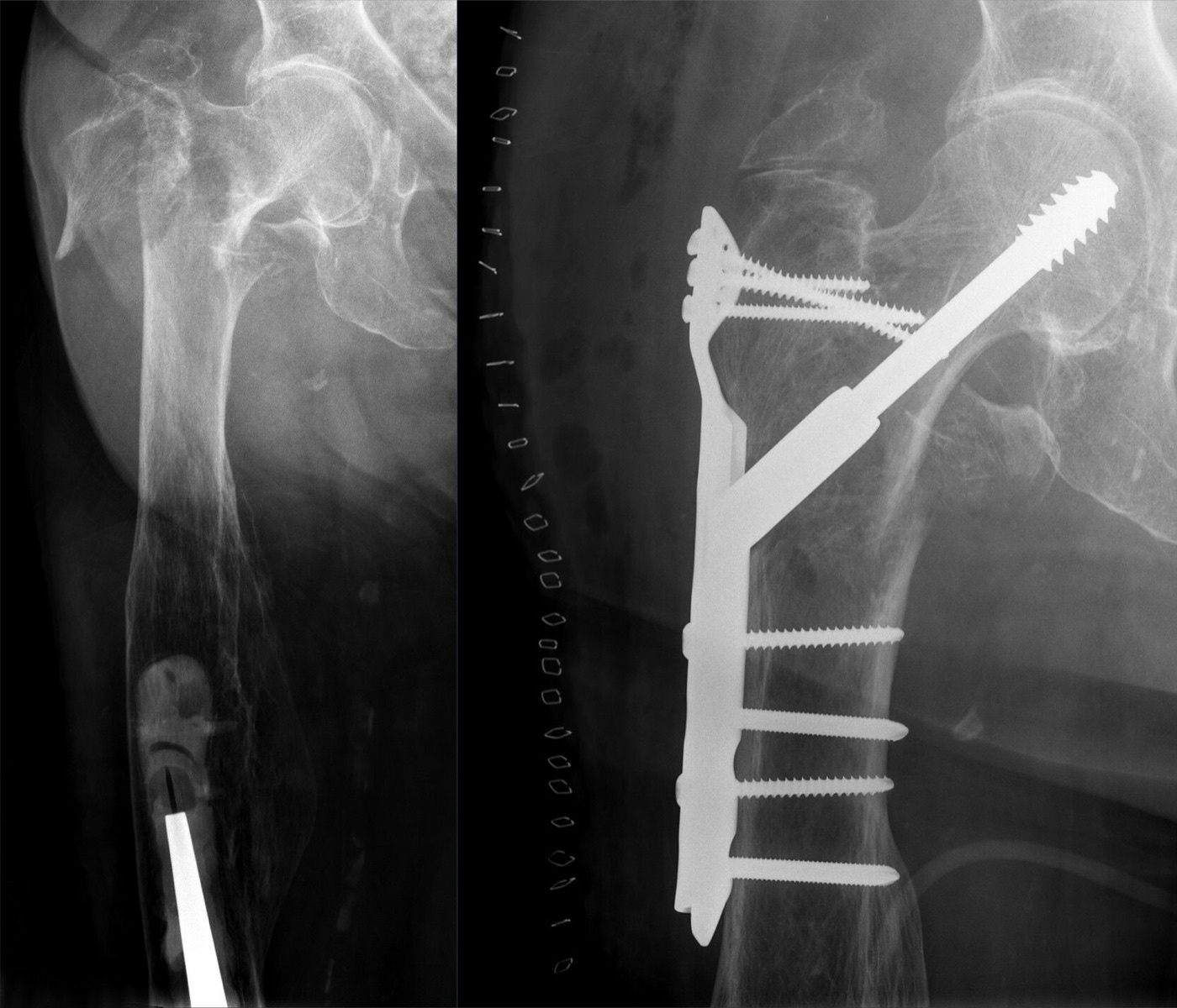 Figure 5. A pertrochanteric fracture (left) fixed with a dynamic hip screw and lateral side plate plus a trochanteric stabilising plate (right). Hellerhoff, CC BY-SA 4.0, via Wikimedia Commons.