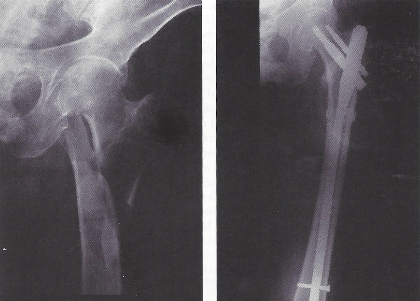 Figure 6. A reverse-obliquity proximal femoral fracture (left) treated with a long cephalomedullary nail and cerclage (right). Mehlauge, CC BY-SA 3.0, via Wikimedia Commons.