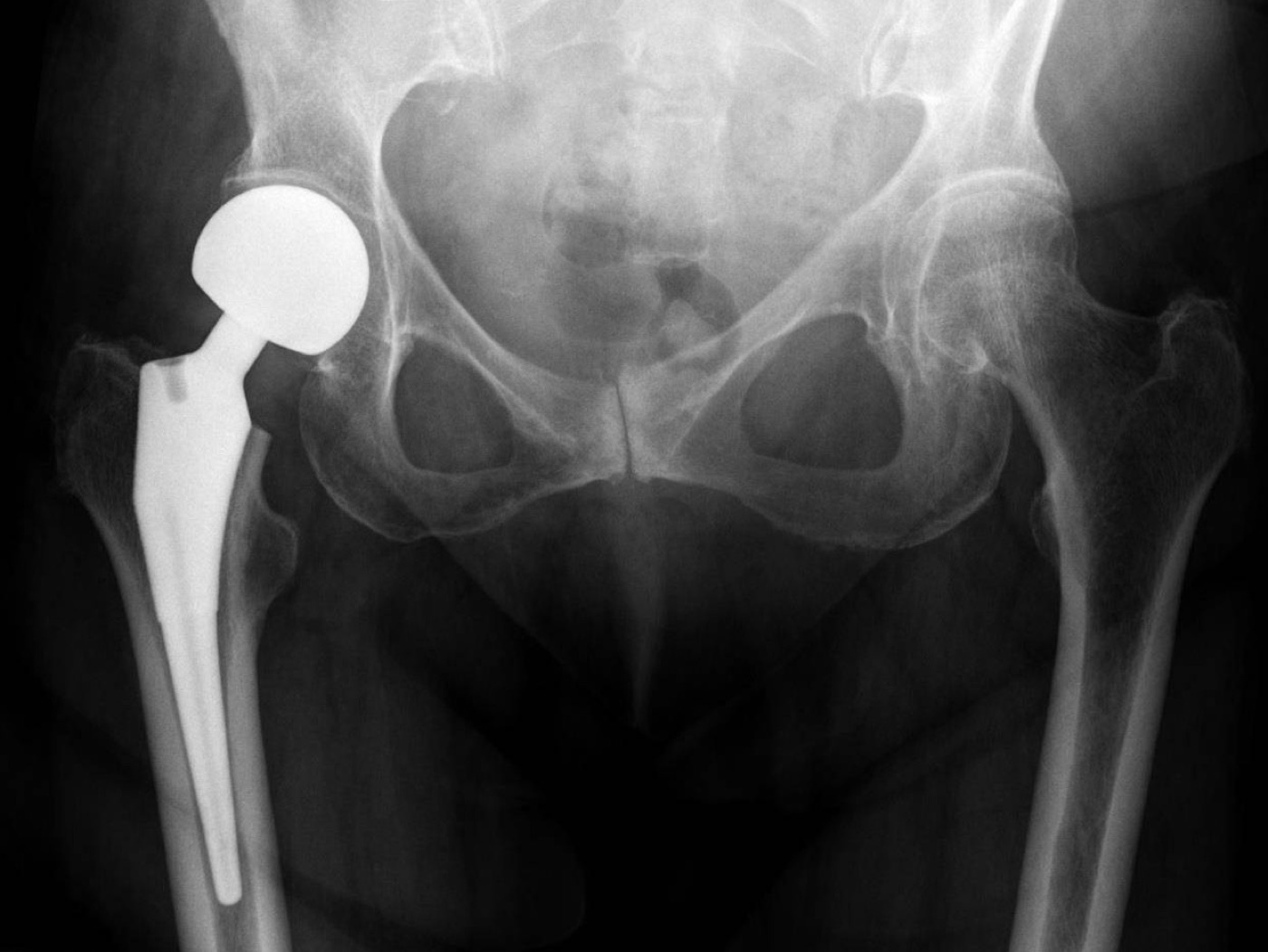 Figure 8. A hip hemiarthroplasty, one arthroplasty option for an unstable proximal-femoral fracture in a frail elderly patient. Jones et al., CC BY 4.0, via Wikimedia Commons.