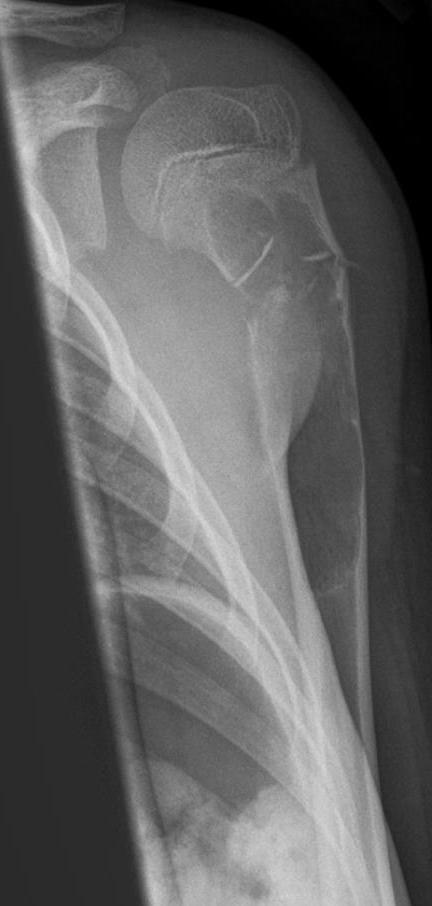 Radiograph. Simple bone cyst of the proximal humerus presenting with a pathological fracture - the typical presentation. Hellerhoff, CC BY-SA 4.0, via Wikimedia Commons.