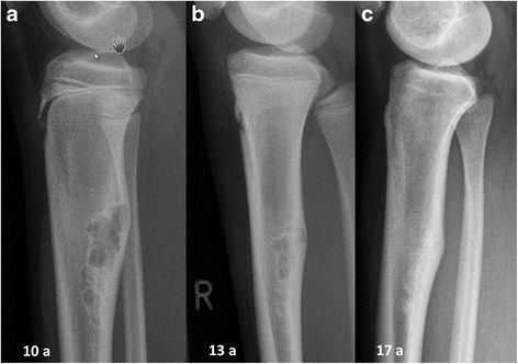 Radiograph. Non-ossifying fibroma - natural history at ages 10, 13 and 17: the eccentric proximal-tibial lesion progressively ossifies and heals. Herget et al., CC BY 4.0, via Wikimedia Commons.