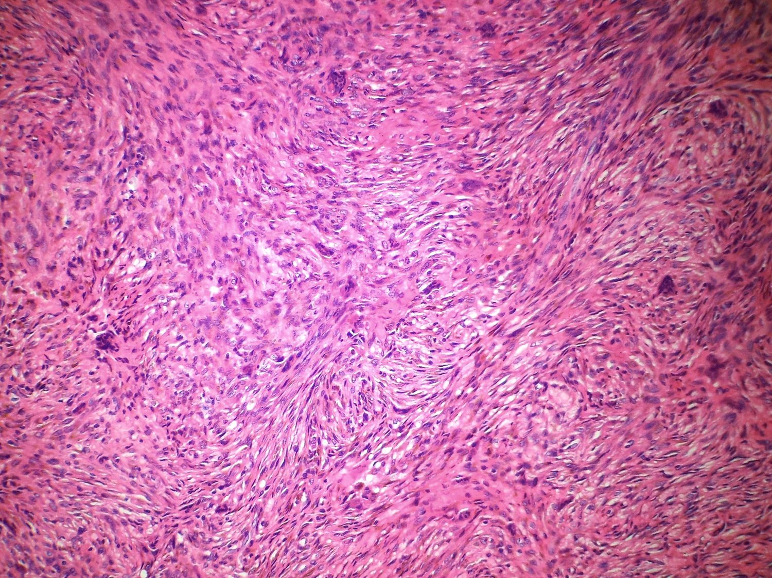 Histology. Non-ossifying fibroma - a storiform (cartwheel) spindle-cell proliferation with admixed multinucleated giant cells and no bone formation. Sarahkayb, CC BY-SA 4.0, via Wikimedia Commons.