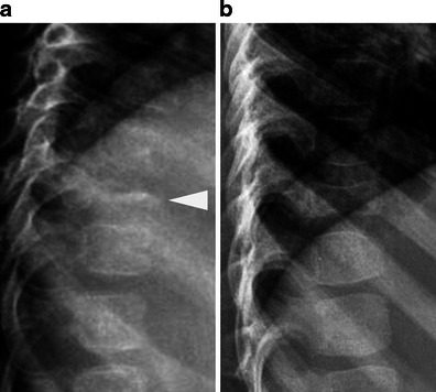 Radiograph. Vertebra plana - uniform vertebral collapse with preserved disc spaces; note partial reconstitution at follow-up. Khung et al., Insights into Imaging 2013, CC BY.