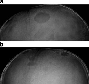 Radiograph. Langerhans cell histiocytosis - well-defined “punched-out” lytic lesions of the calvaria. Khung et al., Insights into Imaging 2013, CC BY.