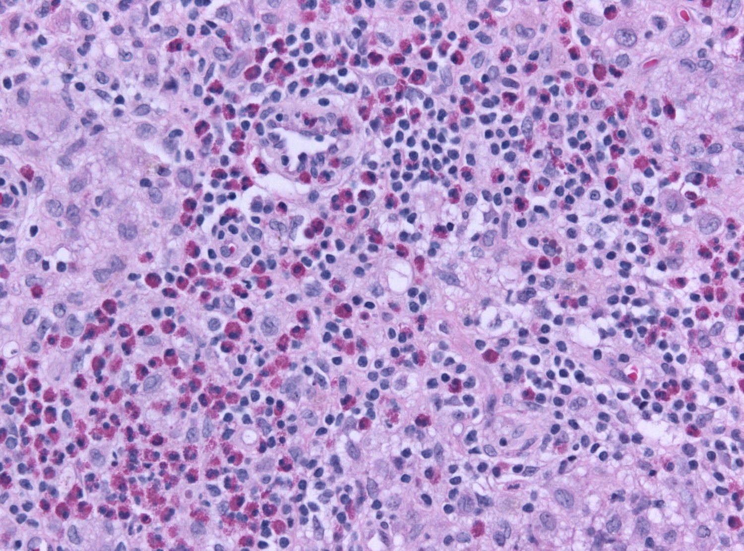 Histology. Langerhans cell histiocytosis - pale Langerhans cells with grooved “coffee-bean” nuclei admixed with abundant eosinophils. Jensflorian, CC BY-SA 3.0, via Wikimedia Commons.