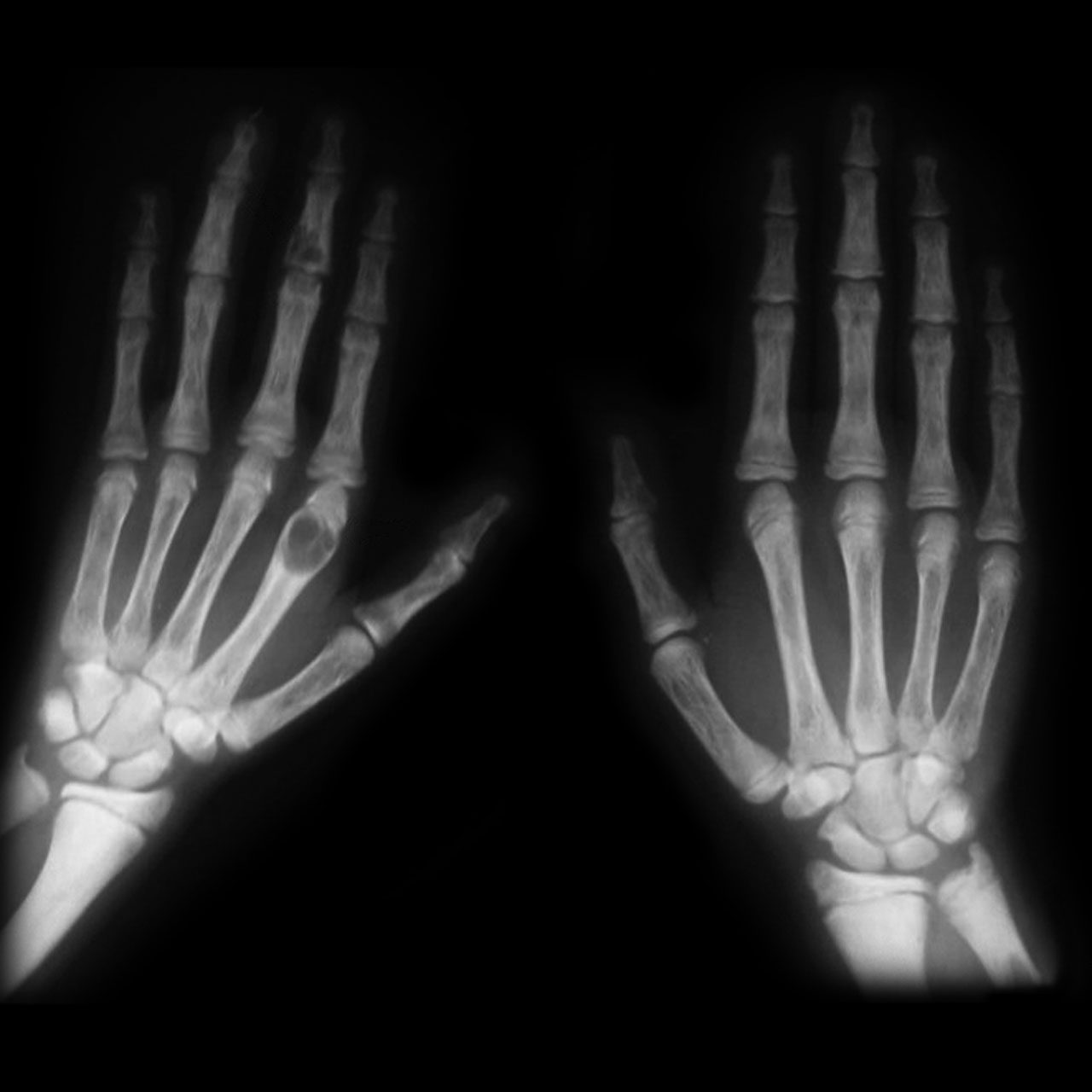 Radiograph. Brown tumours of hyperparathyroidism - lytic lesions in the bones of the hand. Frank Gaillard, CC BY-SA 3.0, via Wikimedia Commons.