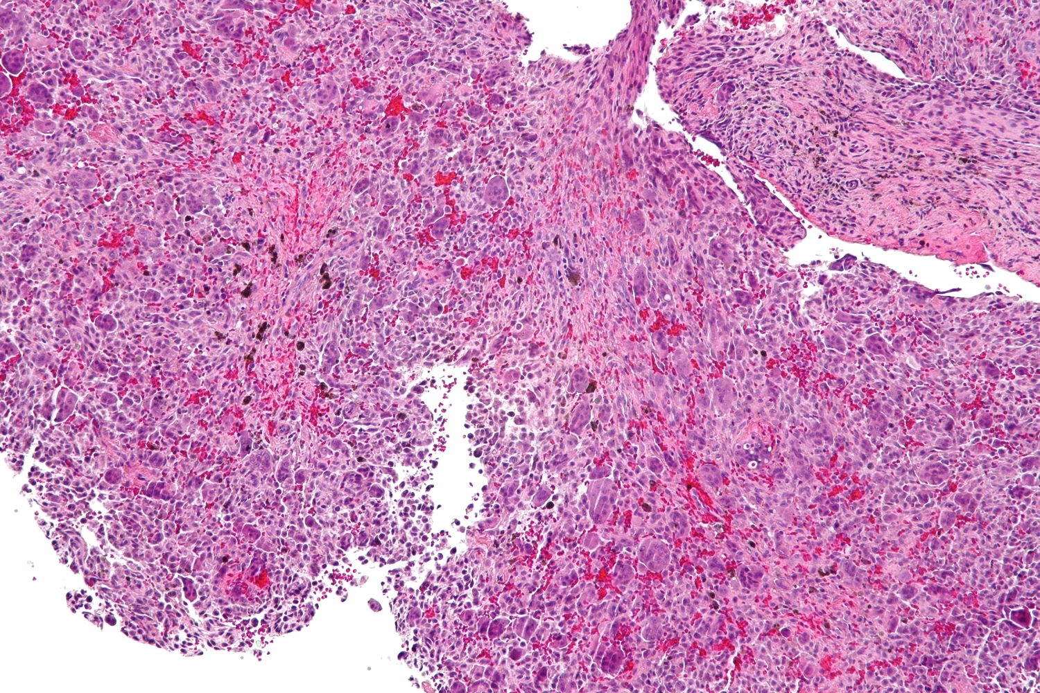 Histology. Giant-cell (reparative) granuloma - giant cells unevenly clustered around foci of haemorrhage in a spindle-cell stroma (contrast with the even distribution in giant-cell tumour). Nephron, CC BY-SA 3.0, via Wikimedia Commons.